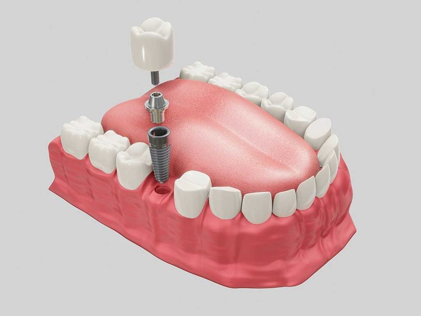 Ilustração de um implante dentário com coroa posicionado na arcada