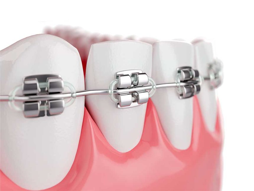 Aparelho ortodôntico fixo nos dentes